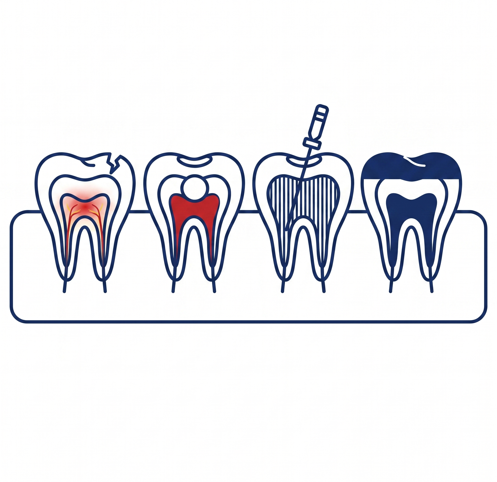 Root Canal Treatment